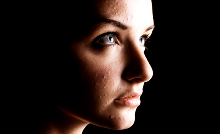 8 Effective Ways To Fight Acne